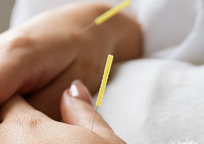 Acupuncture